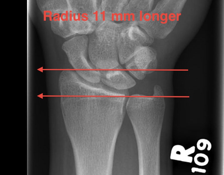 Normal Radial Length